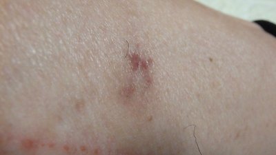 2ヶ月たっても治らない傷痕